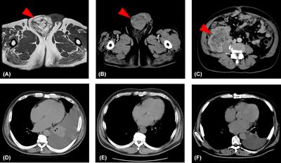 Case report: Paratesticular dedifferentiated liposarcoma with poor prognosis